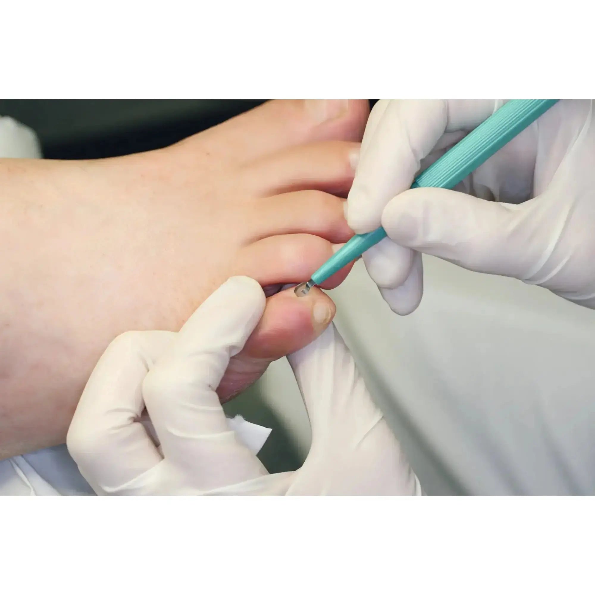 Hautkürette - Länge: 15 cm - Ruck Ruck 