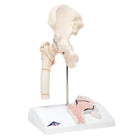 Frattura del femore e usura dell'articolazione dell'anca - Anatomia e patologia